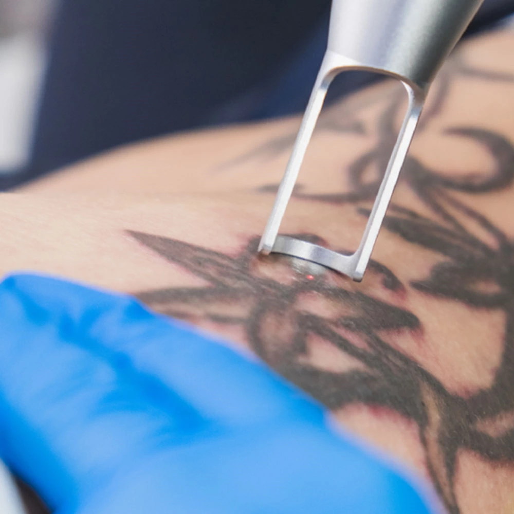 Suppression de tatouage : options et résultats